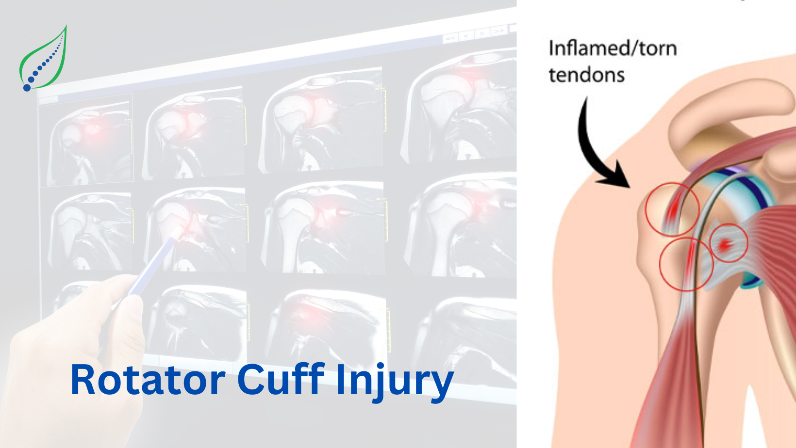 Rotator Cuff Tear